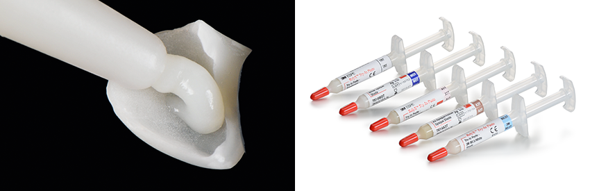 3M™ RelyX™ Veneer Try-In-Pasten in verschiedenen Farbtönen, die zu 3M™ RelyX™ Veneer und 3M™ RelyX™ Universal Befestigungskomposit passen. Bilder mit freundlicher Genehmigung von Dr. Paulo Monteiro.